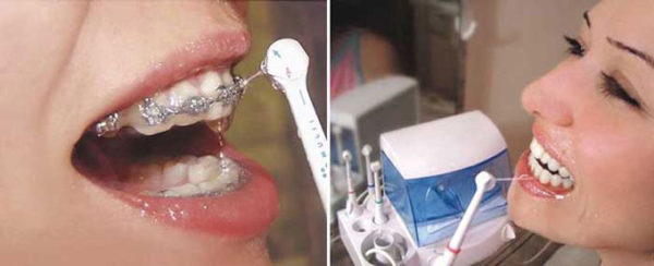 Using irrigator for braces Using irrigator for braces