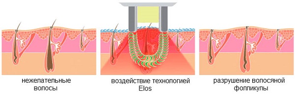 Elos Hair Removal Technology