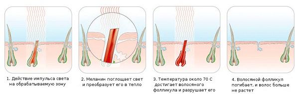 The principle of the photoepilator