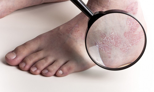Eczema on the legs
